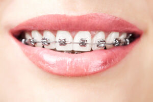 Orthodontics Beyond Braces - Sculpting Perfect Smiles in Airdrie