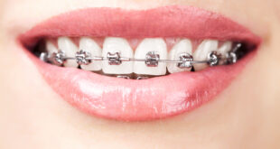 Orthodontics Beyond Braces - Sculpting Perfect Smiles in Airdrie